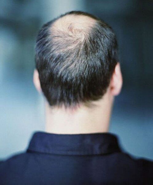 saç dökülmesi nedir erkeklerde tedavi yöntemleri