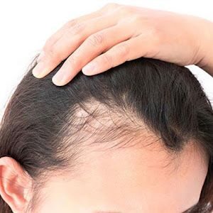 saç dökülmesi için önlemler