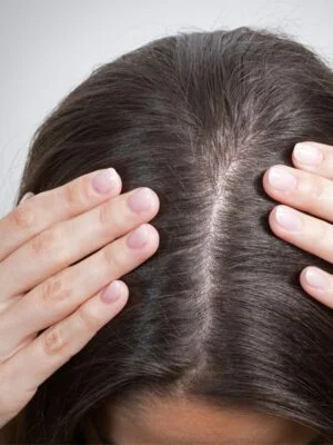 Saç Dökülmesini önlemek için 5 Öneri